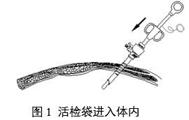 一次性使用內(nèi)窺鏡用活檢袋注冊(cè)審查指導(dǎo)原則(2025年第20號(hào))(圖1) 一次性使用內(nèi)窺鏡用活檢袋注冊(cè)審查指導(dǎo)原則(2025年第20號(hào))(圖1)