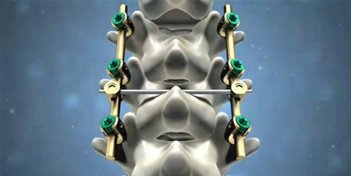 脊柱后路內(nèi)固定系統(tǒng)注冊技術(shù)審查指導(dǎo)原則(2016年第70號)(圖1) 脊柱后路內(nèi)固定系統(tǒng)注冊技術(shù)審查指導(dǎo)原則(2016年第70號)(圖1)